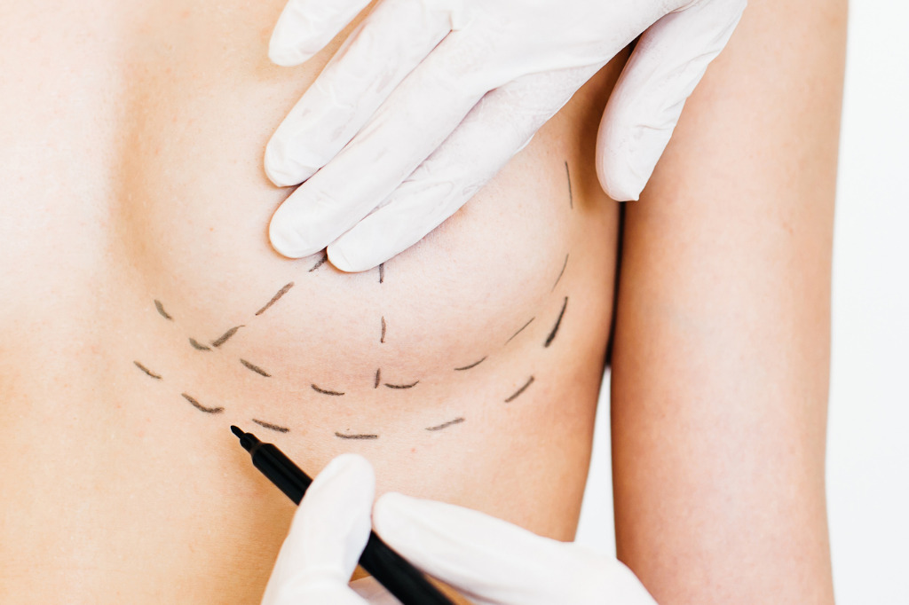 Leia mais sobre o artigo Mamoplastia com implante